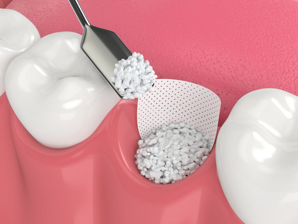 Bone grafting socket being filled