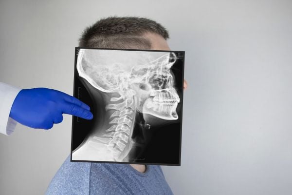 Facial fracture xray imaging
