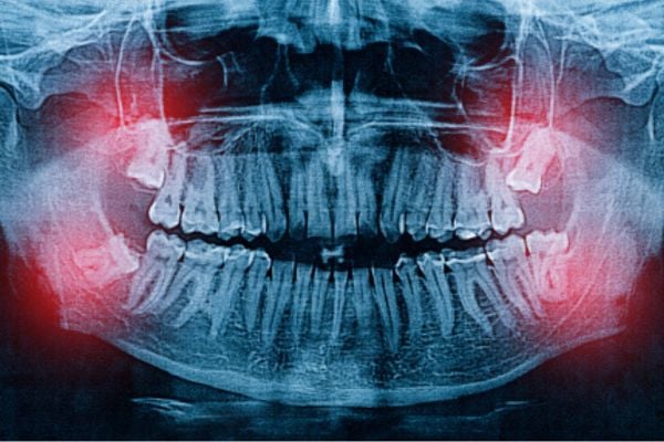 Wisdom Tooth X-ray