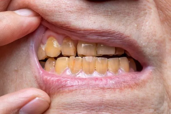 Discolored teeth caused by smoking