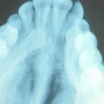 impacted-tooth1-full
