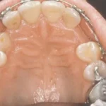 impacted-tooth2-full