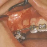 impacted-tooth3-full