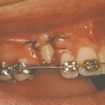 impacted-tooth4-full