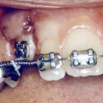 impacted-tooth5-full