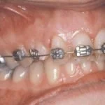 impacted-tooth6-thumb