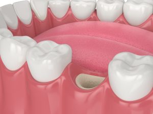 Bone grafting empty socket