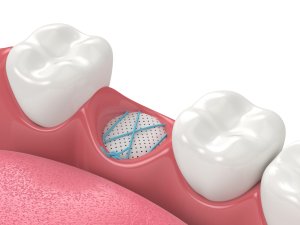 Bone grafting socket healing