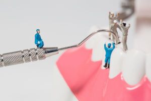 Dental Implant Maintenance