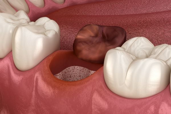 chewing tobacco dry socket risk study What is a dry socket and how do you prevent it? chewing tobacco dry socket risk study What is a dry socket and how do you prevent it?