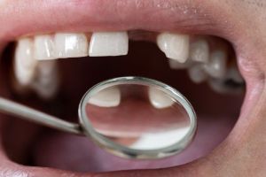 Image of a person missing a tooth