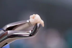 Image of an extracted tooth