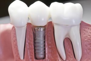 Dental Implants Image