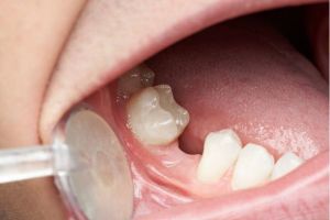 Image of a Missing Tooth