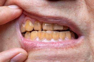 Discolored teeth caused by smoking