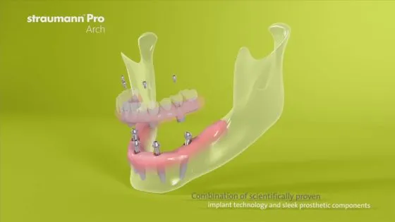 Straumann Pro Arch thumbnail